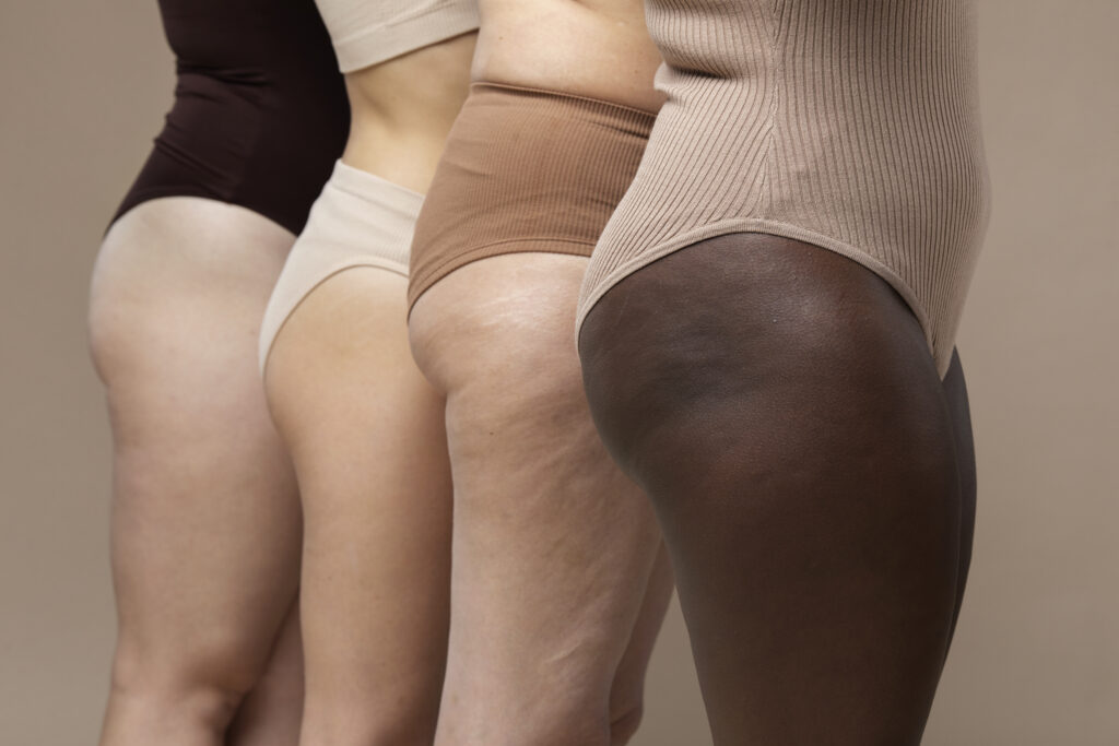 Lipedema: quando o acúmulo de gordura vai além da estética